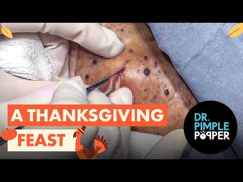 Dr Pimple Popper's 2024 Thanksgiving Mashup! Which is your Favorite?