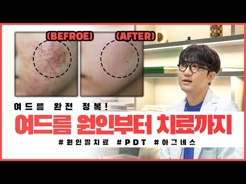 효과 있는 여드름 치료 방법은? 원인을 알아야 치료가 됩니다 :) #여드름치료 #아그네스