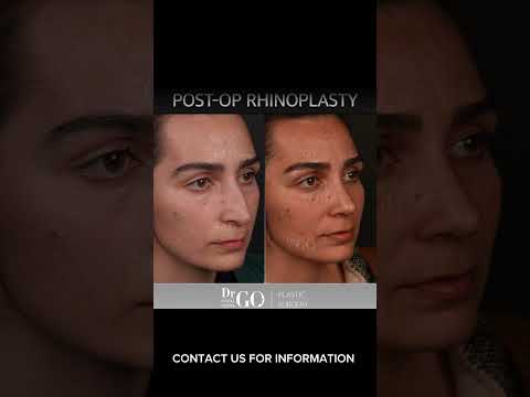 Before and after rhinoplasty - Dr Guncel Ozturk #beforeandafter #rhinoplastyturkey #drgo