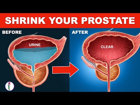 Strictly Avoid these 5 Foods if you have Enlarged Prostate | Prostate Enlargement Treatment | BPH