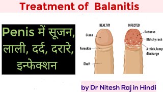 Balanitis,crack on penis foreskin,candidiasis, medicines for penis infection #drniteshraj in Hindi