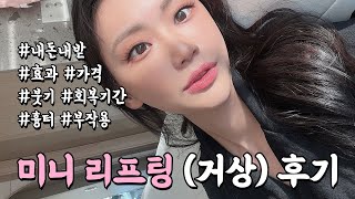 vlog ♥ 미니리프팅(미니거상) 내돈내산 시술 후기 브이로그. (효과, 가격, 붓기, 회복기간, 흉터, 부작용, 전후 다 알려줌)