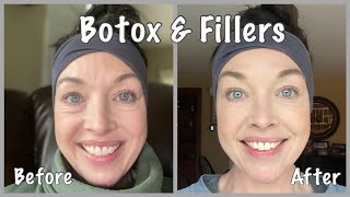 Botox & Fillers For Under Eye Bags | Before & After   #botox #fillers #undereyebags #beforeandafter