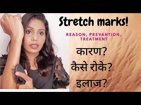 स्ट्रेच मार्क्स | STRETCH MARKS  Reasons, prevention, treatment| my gorgeous ways.