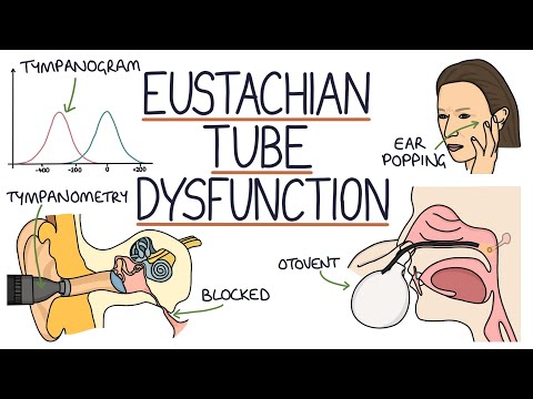 Understanding Eustachian Tube Dysfunction