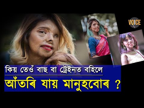 জন্মৰ মাত্ৰ দুমাহতেই এচিড আক্রমণৰ বলি হোৱা এইগৰাকী যুৱতীৰ উজ্জ্বল হাঁহিয়ে এতিয়া জিলিকায় ৰেম্প