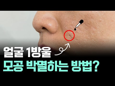 커진 모공 작게 만드는 방법, 피부과 전문의는 이렇게 줄입니다.