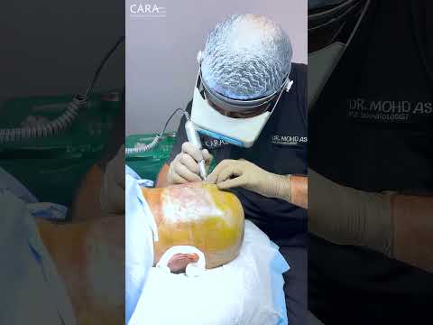 Best Price for Hair Transplant in India at Cara Clinic 2024