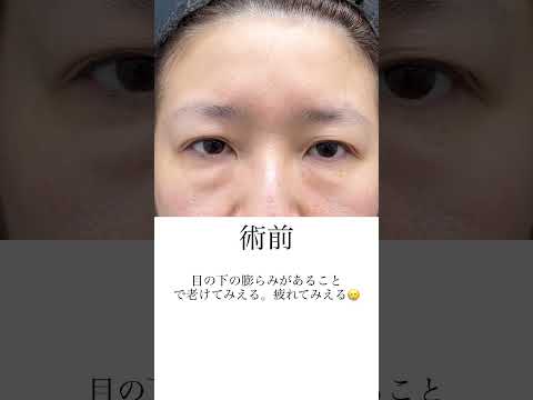 目の下の膨らみある方いませんか？