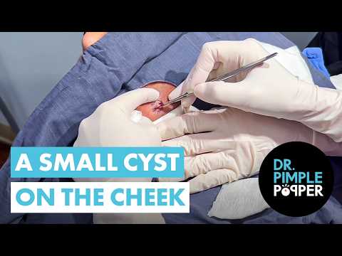 A Small Cyst on the Cheek