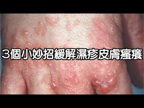 3個小妙招緩解濕疹皮膚瘙癢