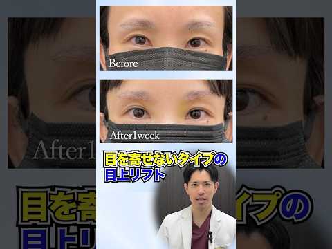 変態的な眉下のこだわり② 眉下＋2種類の目頭切開を使い分けて黒目の内側リフト☆ #眉下切開 #眉下リフト #目上切開