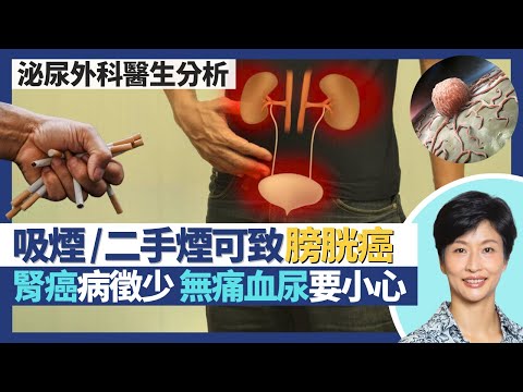 腎癌+膀胱癌（泌尿系統癌症）｜膀胱癌最大成因是吸煙 二手煙亦可致病！腎癌膀胱癌病徵少 血尿而無痛楚或是腫瘤先兆！一種中藥成份可致輸尿管癌｜王建芳醫生 泌尿外科醫生徐學良醫生｜人類健康研究所