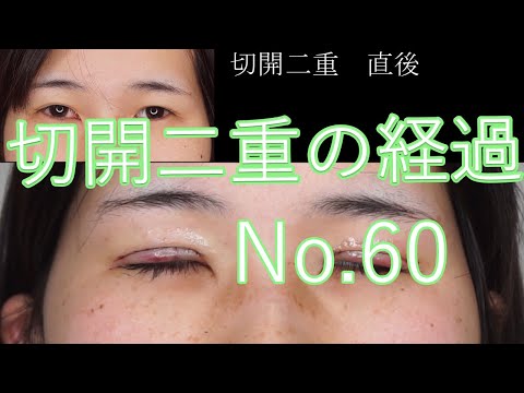 全切開二重手術　60　20代女性