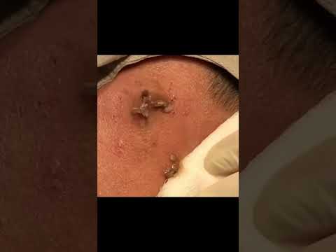 A Never Ending Sac Cyst