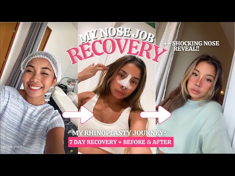 RHINOPLASTY RECOVERY & NOSE REVEAL!!! [ Before & After + Guidelines & Tips ]