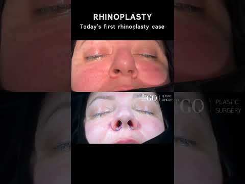 Patient Journey: Rhinoplasty Transformation 🌟