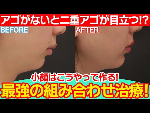 【症例解説】小顔はこうやって作る！！最強の組み合わせ治療