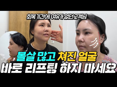 볼살 많고 처진 얼굴 리프팅 | 회복 기간 짧은 얼굴 미니거상 추천_ 모즈의원- 손승용