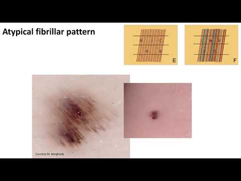 Pigmentation of the Sole - Dr. Michael Marchetti