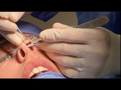 Full RHINOPLASTY aka NOSE JOB Surgery in the Operating Room