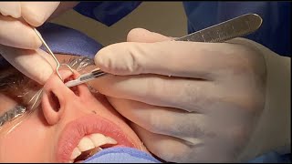 Full RHINOPLASTY aka NOSE JOB Surgery in the Operating Room