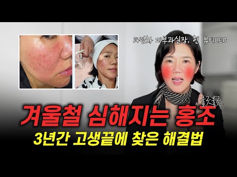 집에서도 가능한 안면홍조없애는방법 4가지 피부과가지마세요!