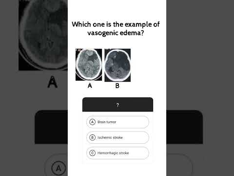 #NEUROQUIZ02 Which one is vasogenic edema? #shorts #short