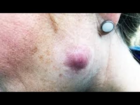 Deep blackheads removal cystic acne treatment with relaxing music - 2021