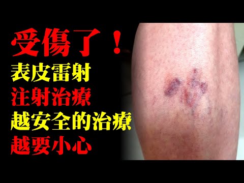 針對網狀靜脈曲張，表皮雷射和注射治療一起用會更好嗎？｜許原彰醫師：台中，高雄，台南，台北，新竹，靜脈曲張專家