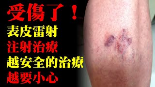 針對網狀靜脈曲張，表皮雷射和注射治療一起用會更好嗎？｜許原彰醫師：台中，高雄，台南，台北，新竹，靜脈曲張專家