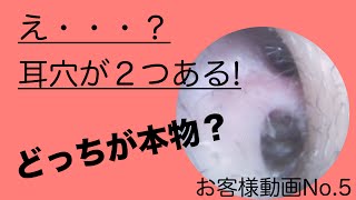 【耳掃除】え・・・？耳の穴が２つ? #5