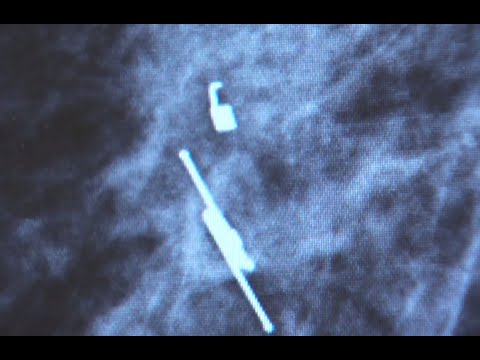 How Breast Biopsies Work