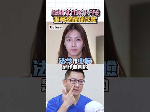 臉部女性柔化 FFS｜ 專業打造柔和曲線 實現理想女性面貌  台北教主 Dr.郭菁松醫師 #臉部柔化手術 #陽剛面貌 #削骨手術 #墊下巴手術 #墊中臉 #台北削骨 #台北醫美 #郭菁松醫師