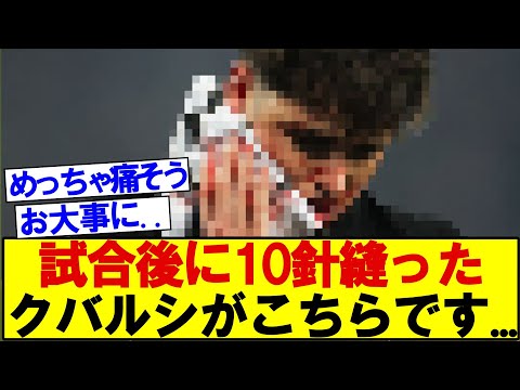 試合後に顔を10針縫ったクバルシがこちらです...