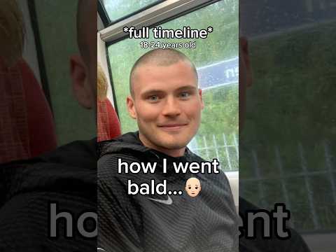 How I went bald…