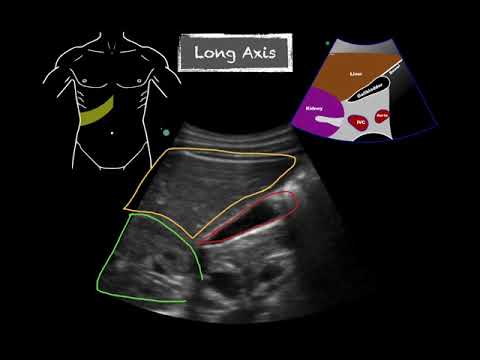 POCUS - Gallbladder Ultrasound Anatomy