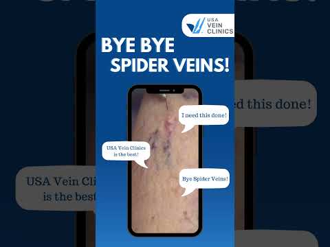 Say Goodbye to Spider Veins with our Sclerotherapy Treatment