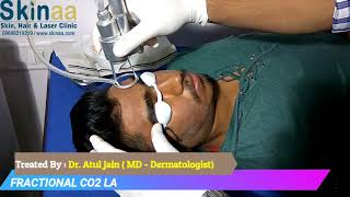 Fractional CO2 Laser Treatment for Acne Scar in Jaipur, India – Dr Atul Jain