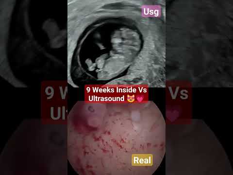 9 Weeks Baby inside vs ultrasound #9weekspregnant #9weeks #babyultrasound #pregnancy