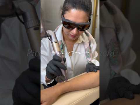 Pico Laser Treatment For Sun Tan Removal | Benefits Of Pico Laser Treatment /