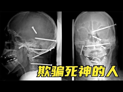 5个欺骗死神活下来的人，男子头部被插6枚钉子，还能活蹦乱跳？