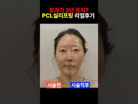 실리프팅이 2년 유지 가능? pcl 효과 장점 찐전후 #pcl #pdo #실리프팅 #리프팅시술 #전후사진 #shorts