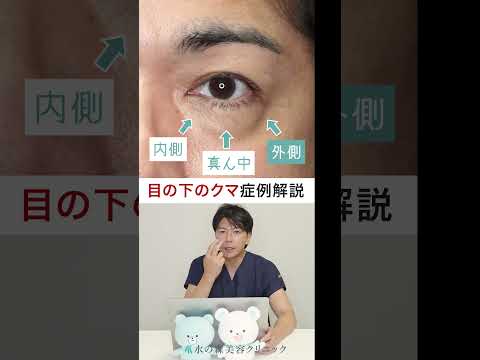 【症例解説】外側まで広がる目の下のクマの原因とは？治療法は？ #shorts #水の森美容クリニック #たるみ #ハムラ法 #裏ハムラ法