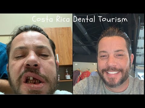 Dental Tourism In Costa Rica, Implants and Veneers,  1 Year Later, Good Or Bad?