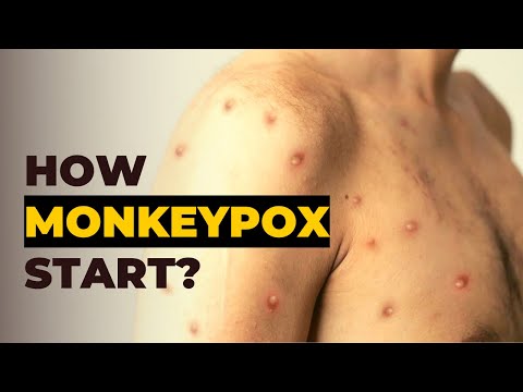 Where did Monkeypox Come From - History of Monkeypox Outbreak