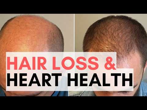 Hair Loss in Men - Real Underlying Cause Explained!