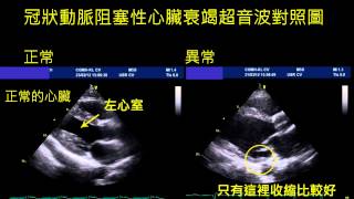 冠狀動脈硬化-超音波檢查對照圖-1