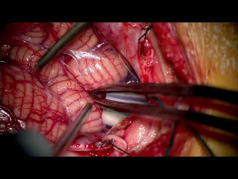 Combined approach (infratentorial supracerebellar–telovelar transventric.) for large brainstem tumor