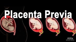 Low Lying Placenta - Placenta Previa, Animation